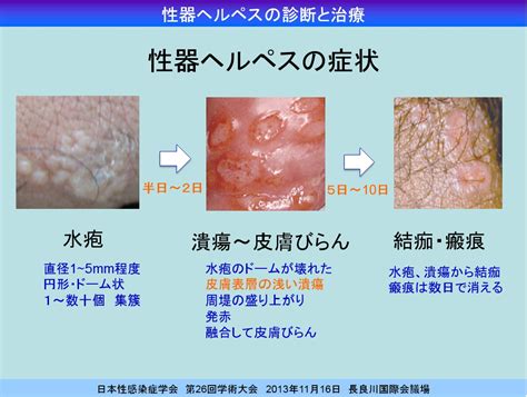 外陰無毛症